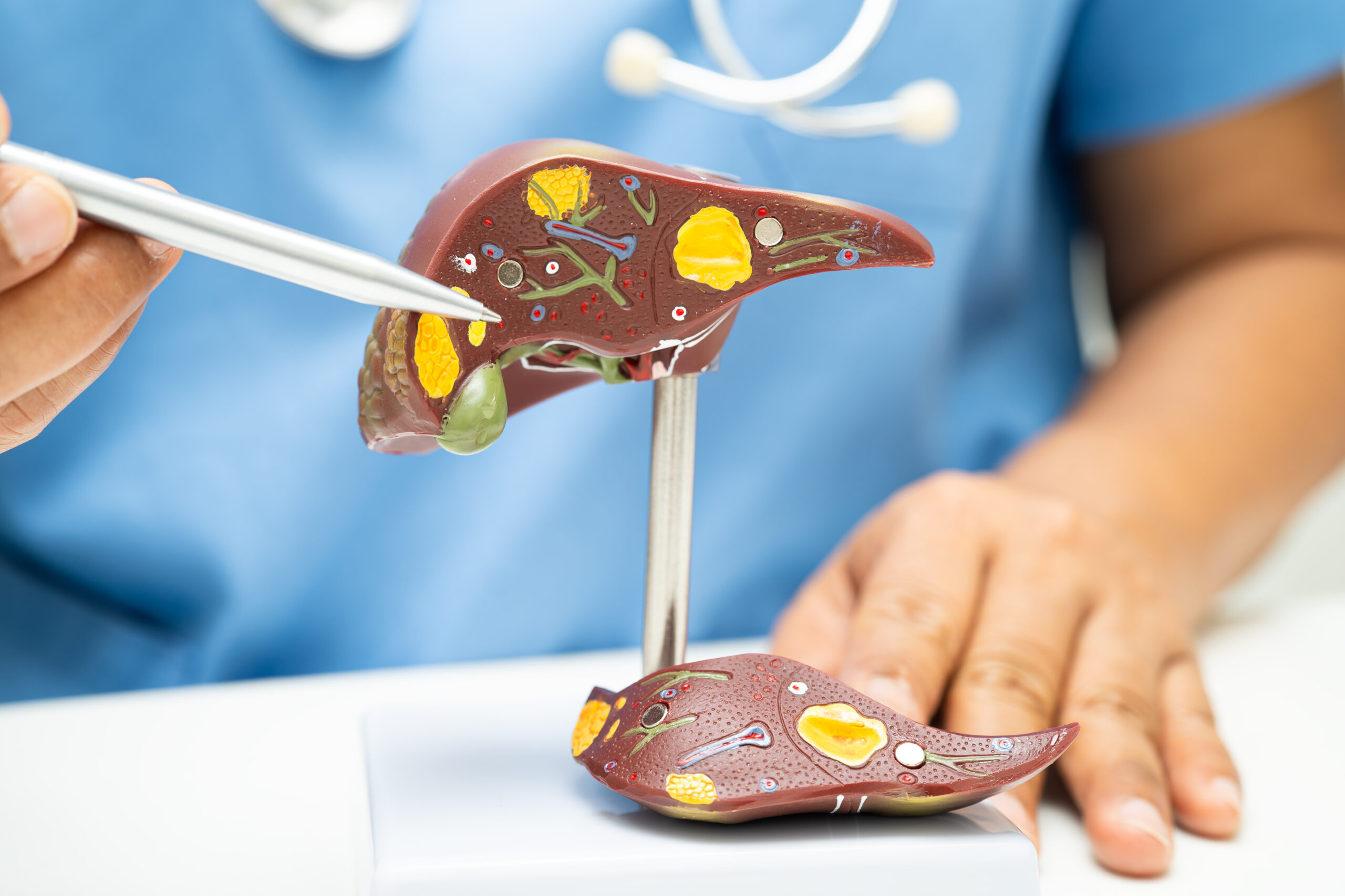 FIB-4: Una herramienta simple para un problema complejo